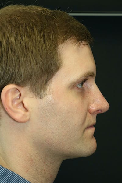 Rhinoplasty Before & After Gallery - Patient 26211163 - Image 2