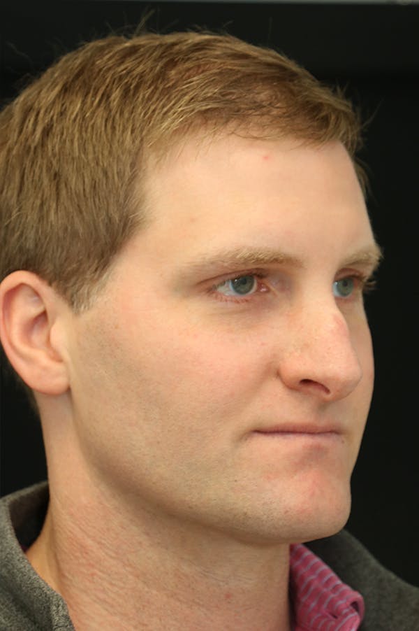 Rhinoplasty Before & After Gallery - Patient 26211163 - Image 3