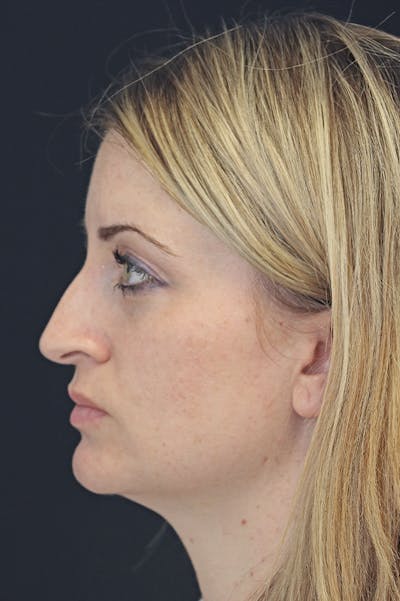 Rhinoplasty Before & After Gallery - Patient 26211164 - Image 1