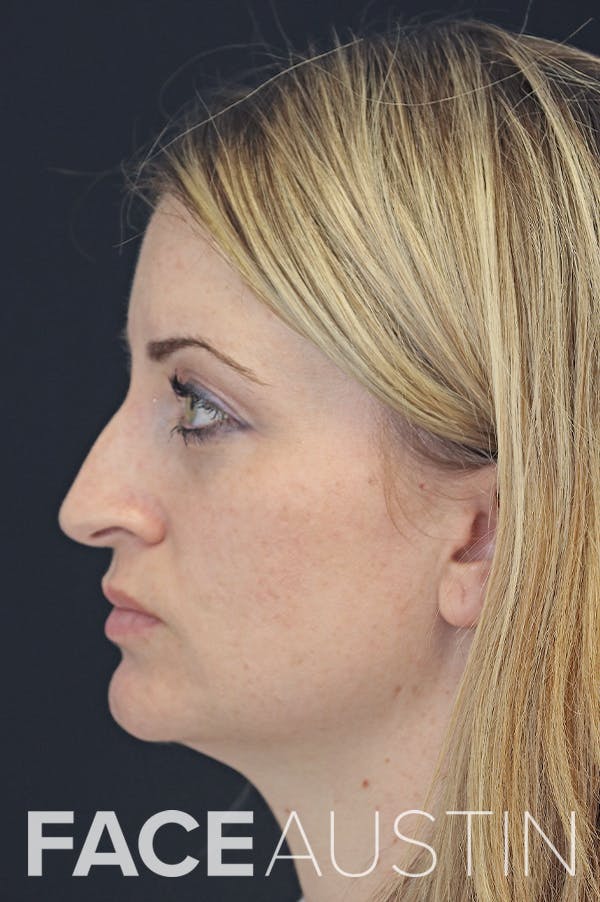 Rhinoplasty Before & After Gallery - Patient 26211164 - Image 1