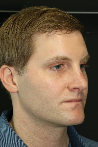 Rhinoplasty Before & After Gallery - Patient 26211163 - Image 4