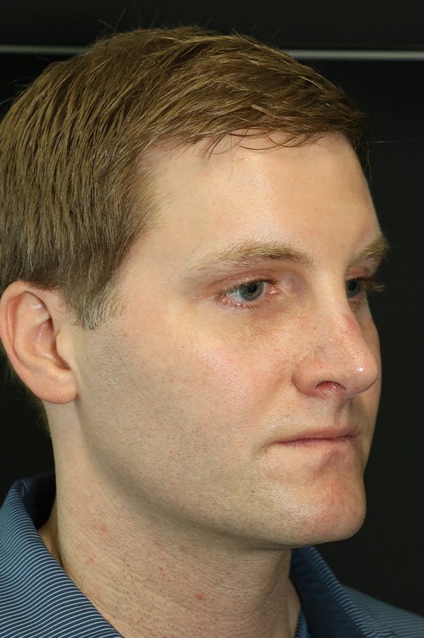 Rhinoplasty Before & After Gallery - Patient 26211163 - Image 4
