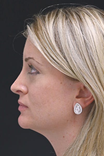 Rhinoplasty Before & After Gallery - Patient 26211164 - Image 2