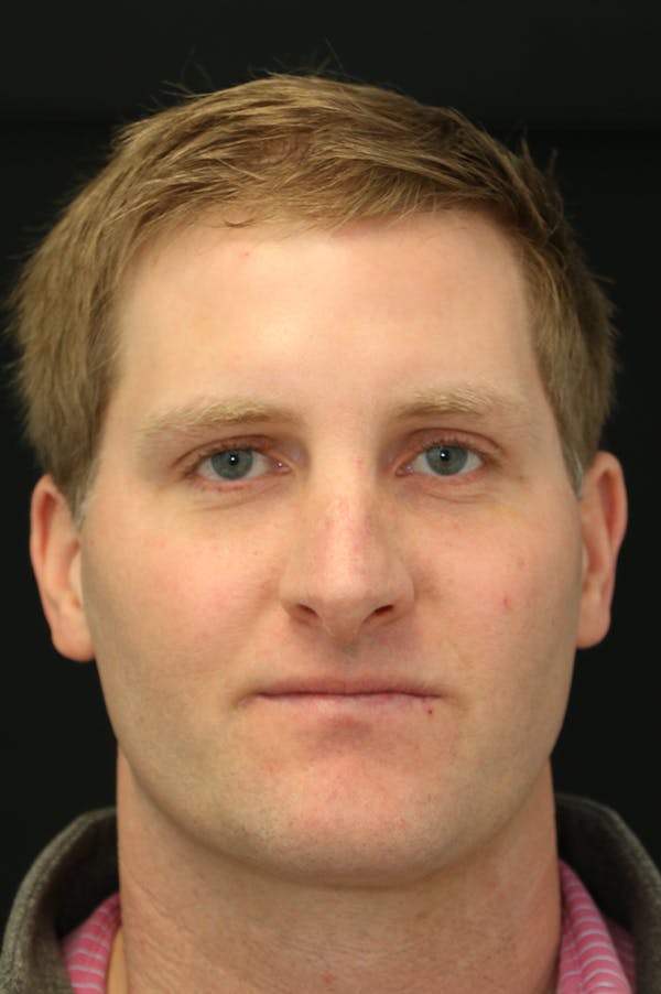 Rhinoplasty Before & After Gallery - Patient 26211163 - Image 5