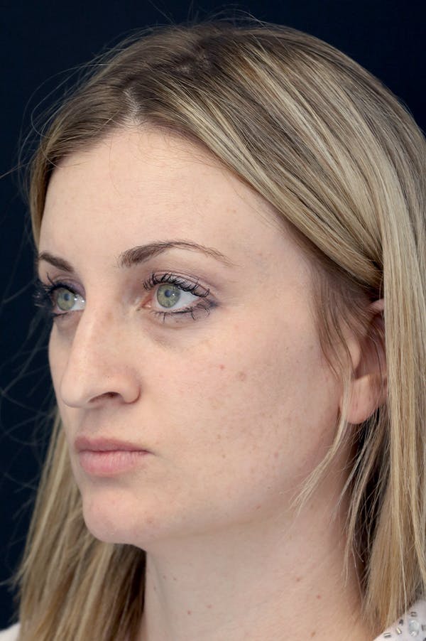 Rhinoplasty Before & After Gallery - Patient 26211164 - Image 3