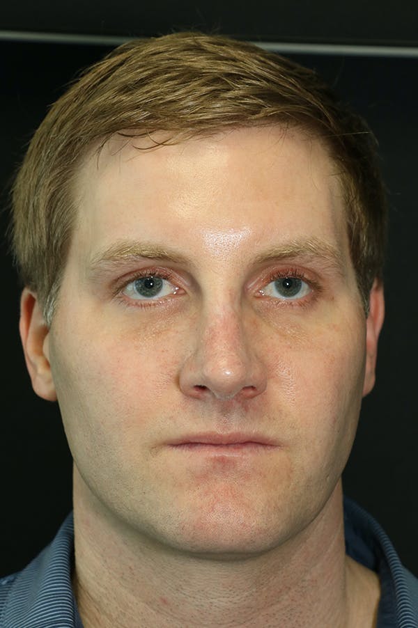 Rhinoplasty Before & After Gallery - Patient 26211163 - Image 6