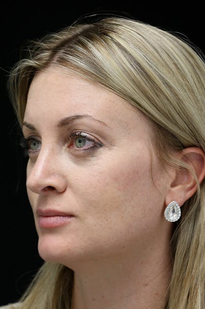 Rhinoplasty Before & After Gallery - Patient 26211164 - Image 4