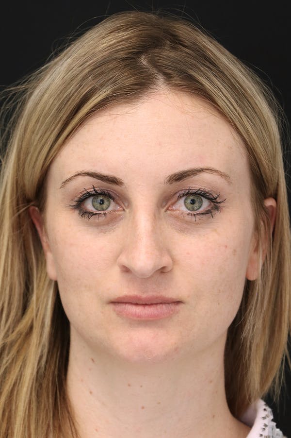 Rhinoplasty Before & After Gallery - Patient 26211164 - Image 5