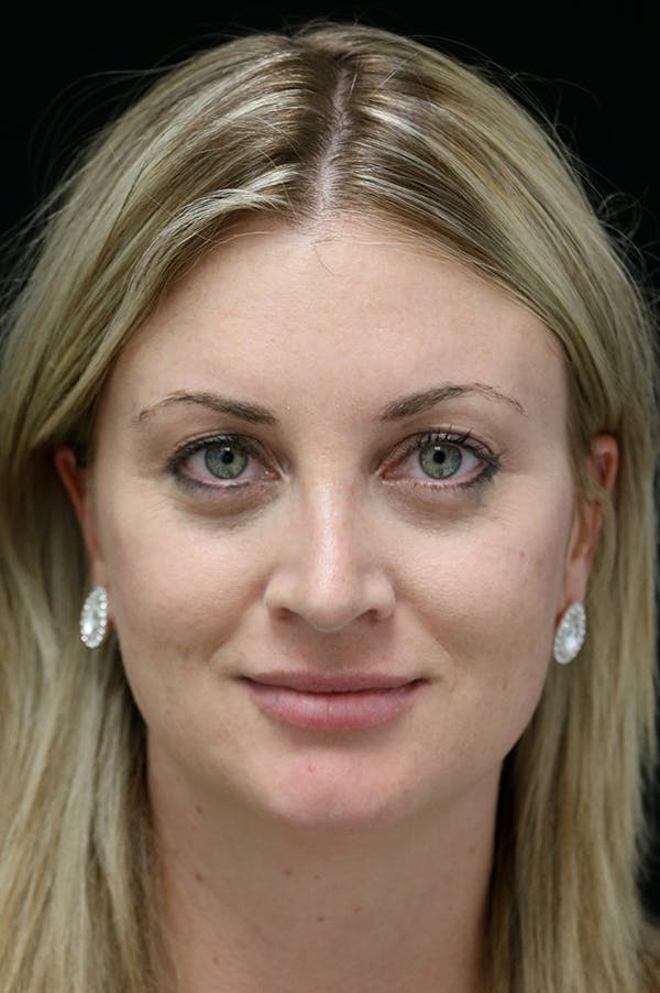 Rhinoplasty Before & After Gallery - Patient 26211164 - Image 6