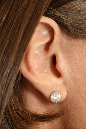 Before & After Photos of Facelift Incisions in Austin by Dr. Antunes