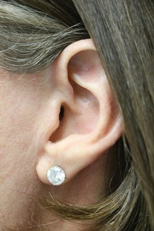 Before & After Photos of Facelift Incisions in Austin by Dr. Antunes