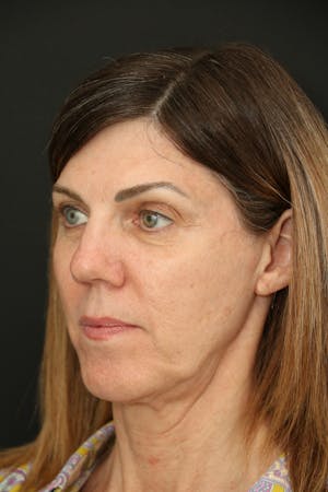 Facelift Incisions