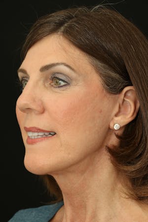 Facelift Incisions