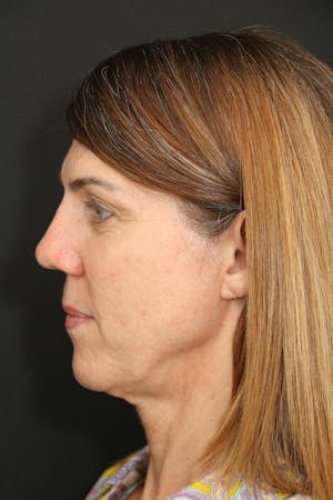 Facelift Incisions