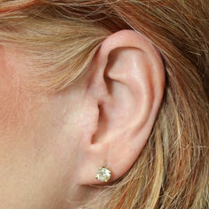 Facelift Incisions