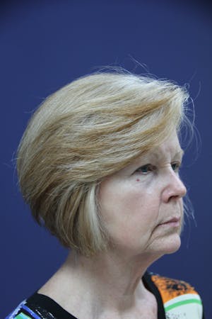 Facelift Incisions