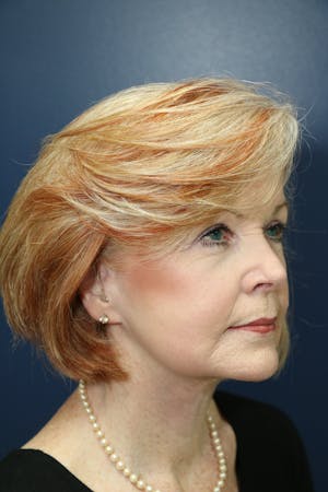 Facelift Incisions