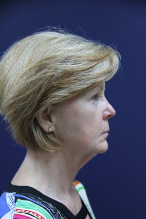 Facelift Incisions