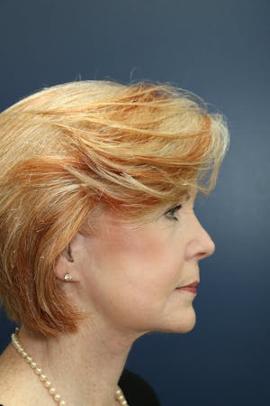 Facelift Incisions
