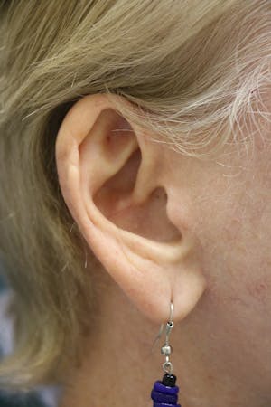 Facelift Incisions