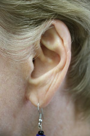 Facelift Incisions