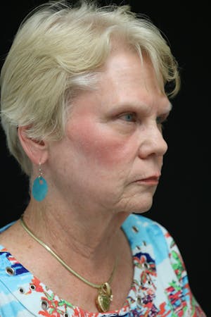 Facelift Incisions