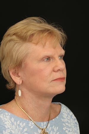 Facelift Incisions