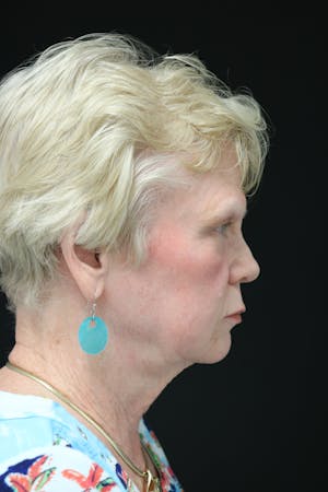 Facelift Incisions
