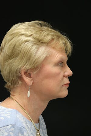 Facelift Incisions