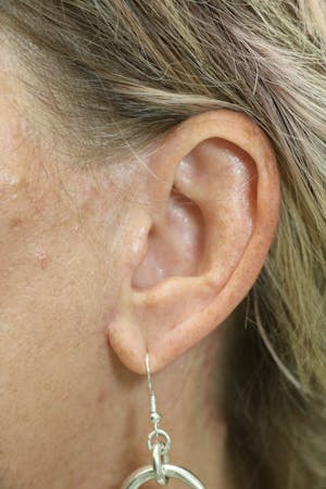 Facelift Incisions