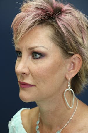 Facelift Incisions
