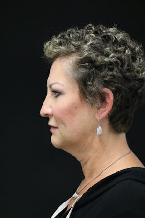 Facelift Incisions