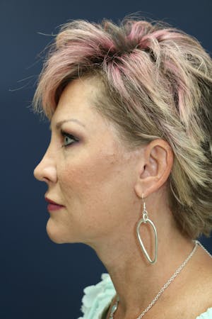 Facelift Incisions