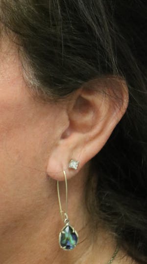 Facelift Incisions