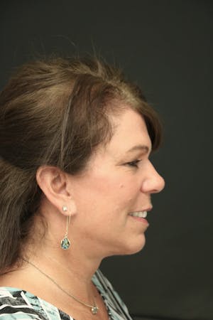 Facelift Incisions