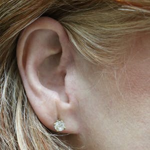 Facelift Incisions
