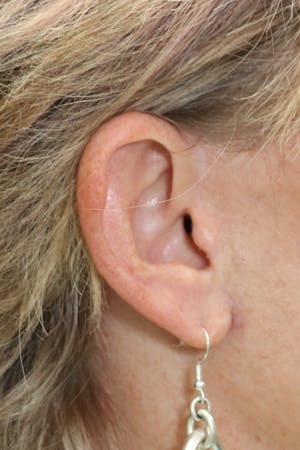 Facelift Incisions
