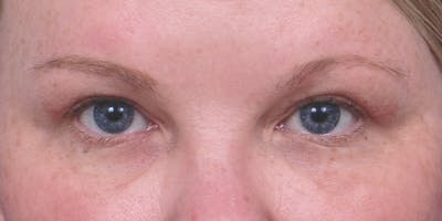 Eyelid Surgery Before & After Gallery - Patient 60806637 - Image 1