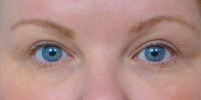 Eyelid Surgery Before & After Gallery - Patient 60806637 - Image 2