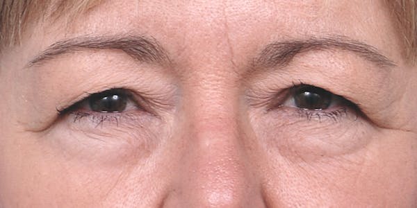 Eyelid Surgery Gallery - Patient 60806638 - Image 1