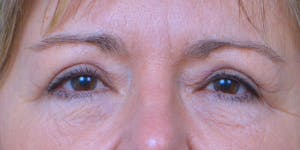 before and after photos of a blepharoplasty in austin by Dr. Antunes
