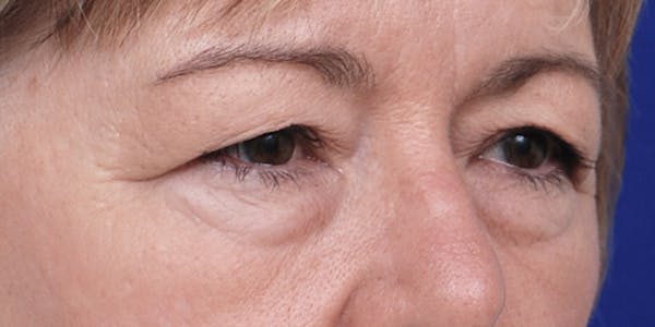 Eyelid Surgery Before & After Gallery - Patient 60806638 - Image 3
