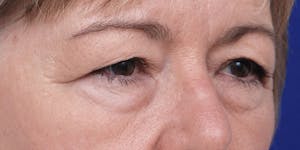 before and after photos of a blepharoplasty in austin