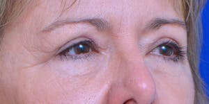 before and after photos of a blepharoplasty in austin