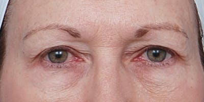 Eyelid Surgery Before & After Gallery - Patient 60806639 - Image 1