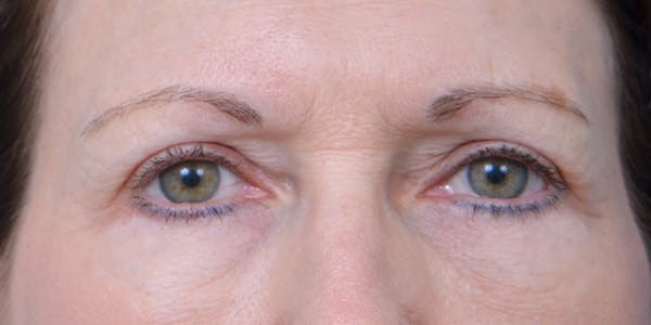 Eyelid Surgery Before & After Gallery - Patient 60806639 - Image 2