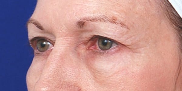 Eyelid Surgery Before & After Gallery - Patient 60806639 - Image 3