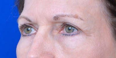 Eyelid Surgery Before & After Gallery - Patient 60806639 - Image 4