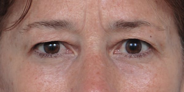 Eyelid Surgery Before & After Gallery - Patient 60806640 - Image 1