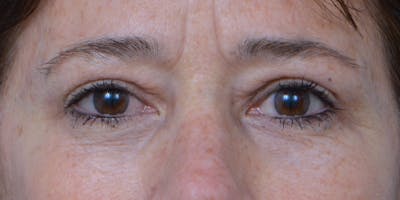 Eyelid Surgery Before & After Gallery - Patient 60806640 - Image 2